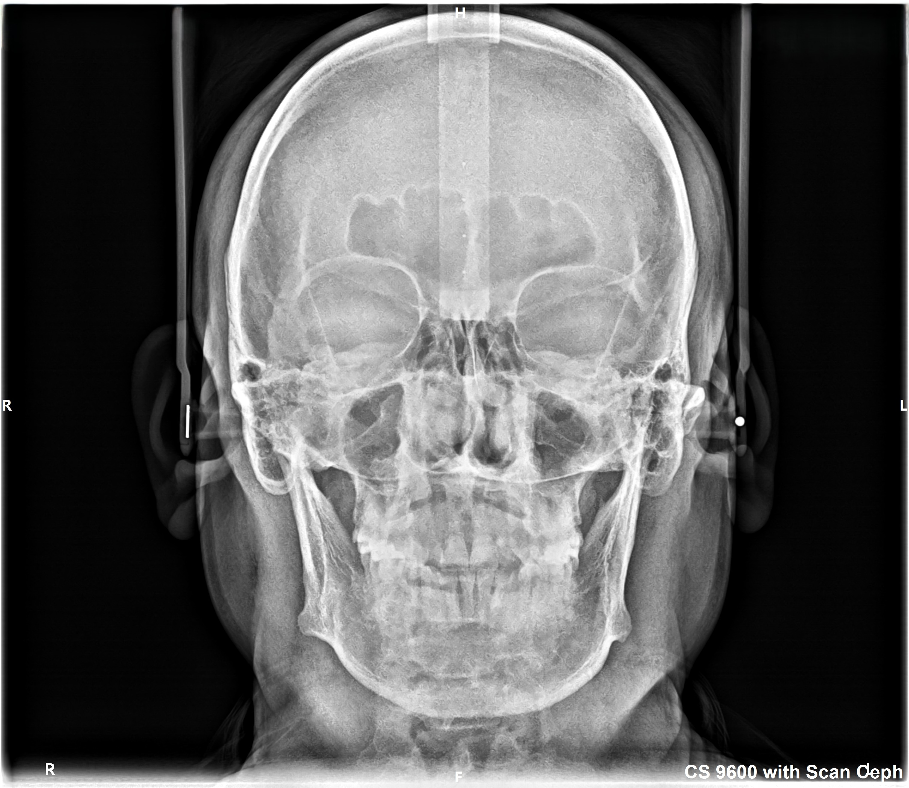 Frontal Ceph