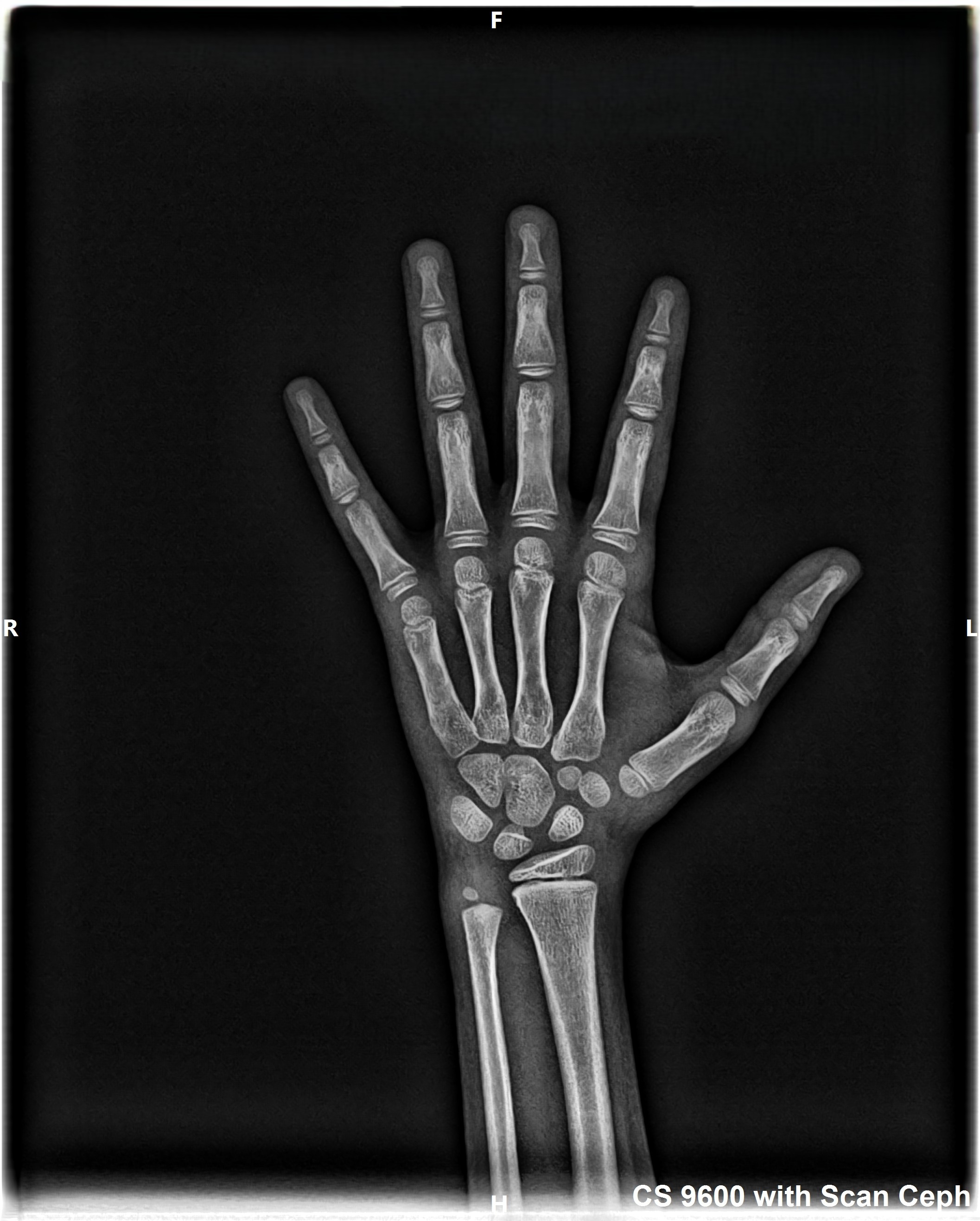 Hand 6