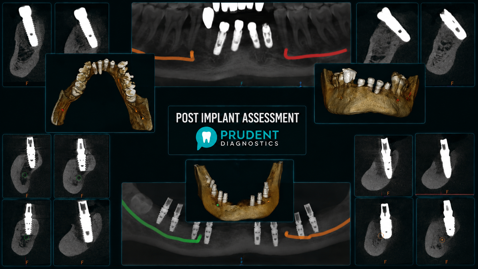 POST IMPLANT ASSESSMENT - Prudent Diagnostics