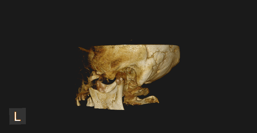 Temporal Bone